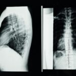 High-resolution X-ray showing a detailed examination of human spine with scoliosis.