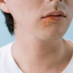 A close-up image of a person's lips showing a cold sore on the lower lip area.