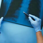 A doctor in blue gloves examines a chest x-ray with a pen, focusing on medical diagnosis.