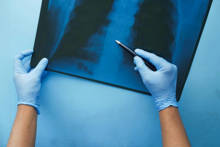 A doctor in blue gloves examines a chest x-ray with a pen, focusing on medical diagnosis.