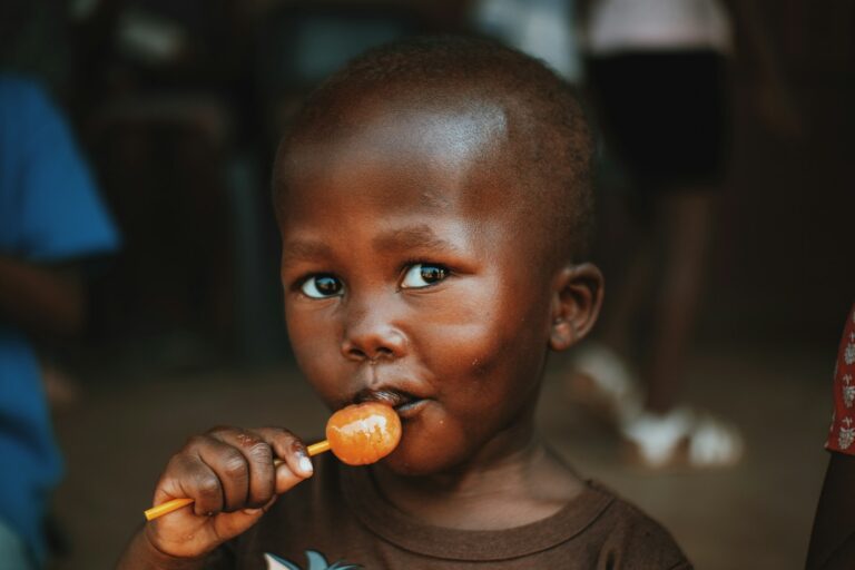 Kwashiorkor-Marasmus a young boy holding an orange in his mouth